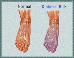 How diabetic neuropathy leads to wounds–wound care center NYC - Wound ...